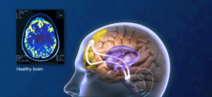 NeuroStar TMS Therapy – The Complete Clinical Solution for Depression