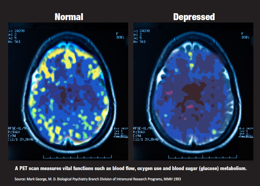 major-depressive-disorder-complications-calgary-guide