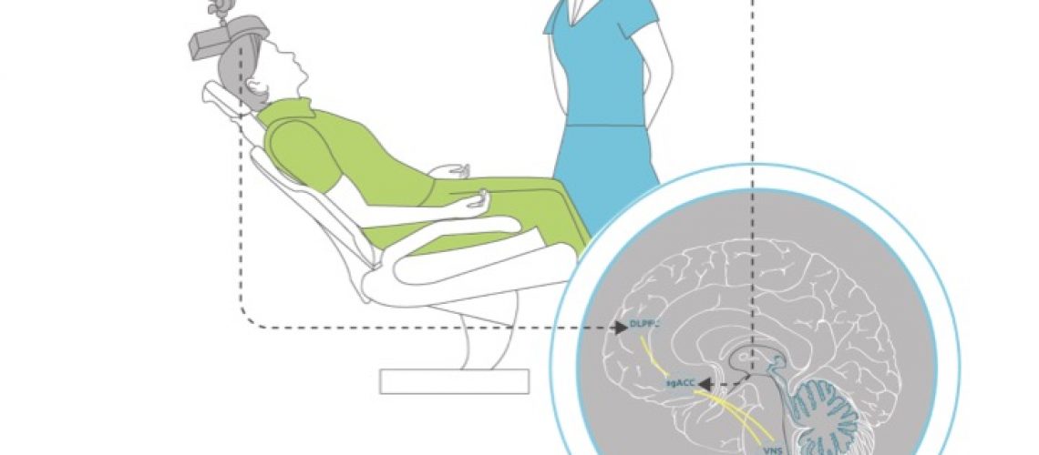 Combined rTMS and Psychotherapy an Effective Treatment for Depression